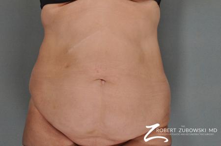 Tummy Tuck: Patient 7 - Before Image 1