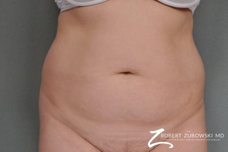 Tummy Tuck: Patient 2 - Before Image 1