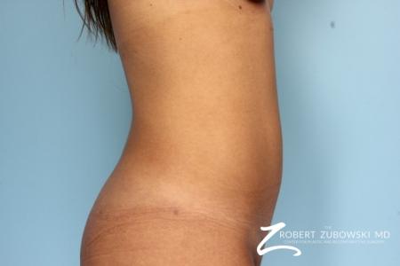 Liposuction: Patient 11 - After Image 2