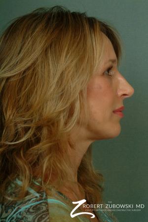 Chin Augmentation: Patient 3 - After Image 2
