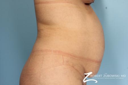 Tummy Tuck: Patient 20 - Before and After Image 2