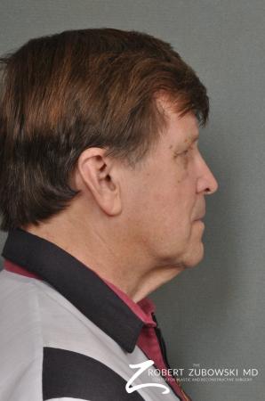 Neck Lift: Patient 3 - Before Image 2