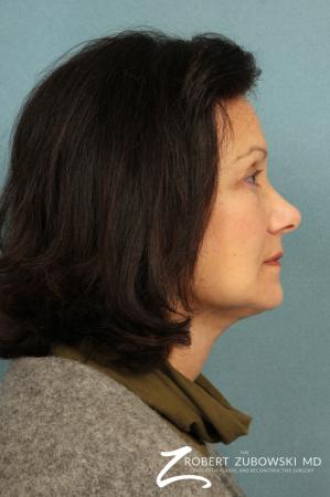Facelift: Patient 22 - After Image 2
