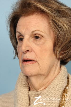 Blepharoplasty: Patient 36 - Before and After Image 3