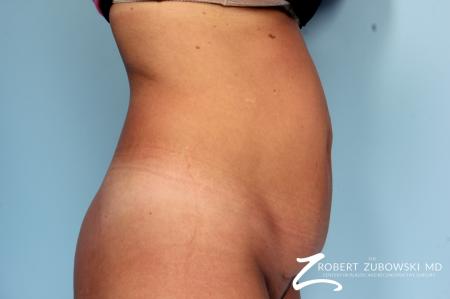 Tummy Tuck: Patient 9 - Before and After Image 2