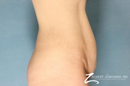 Tummy Tuck: Patient 12 - Before and After Image 2