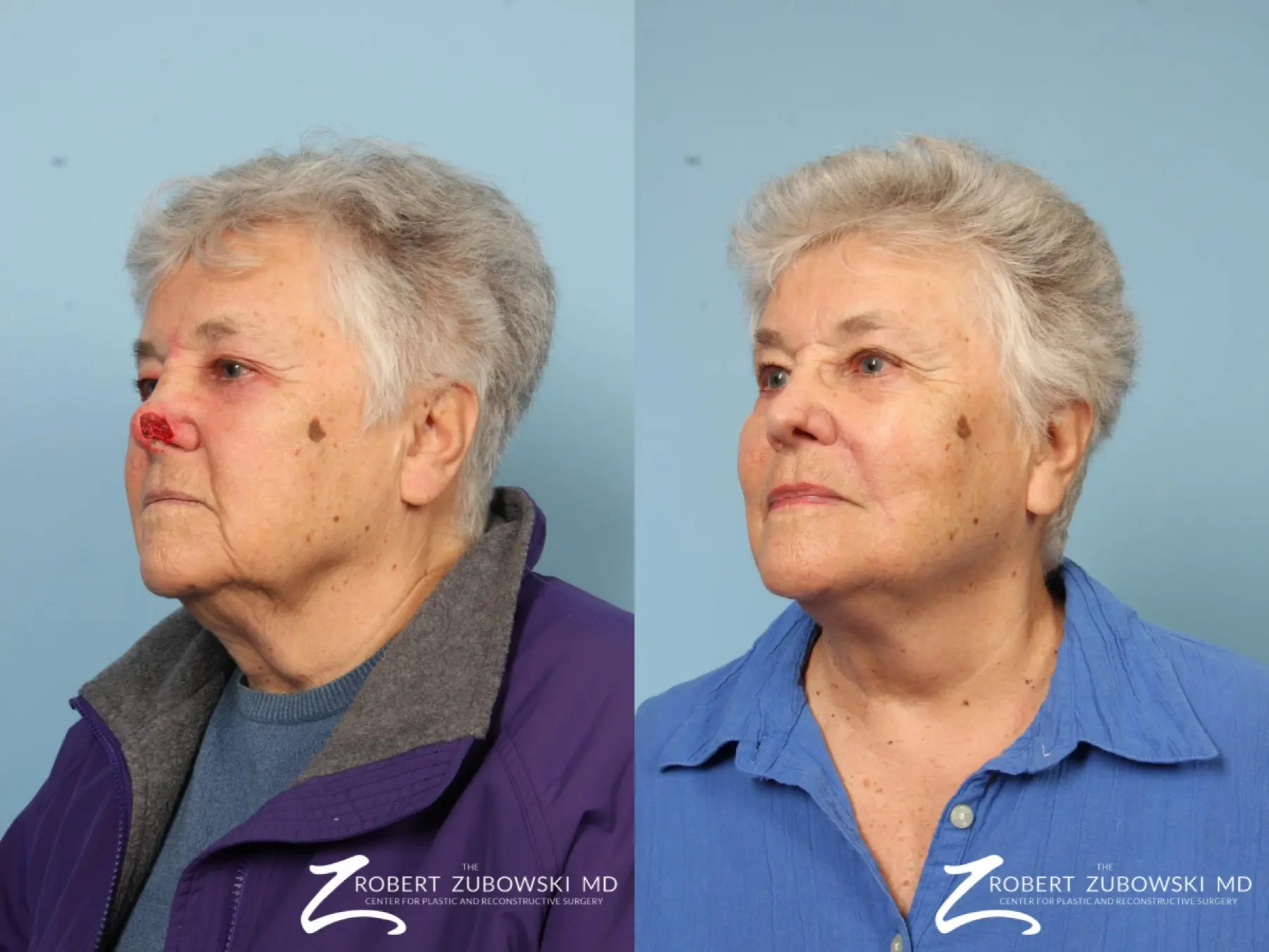 Mohs Closure: Patient 5 - Before and After 2