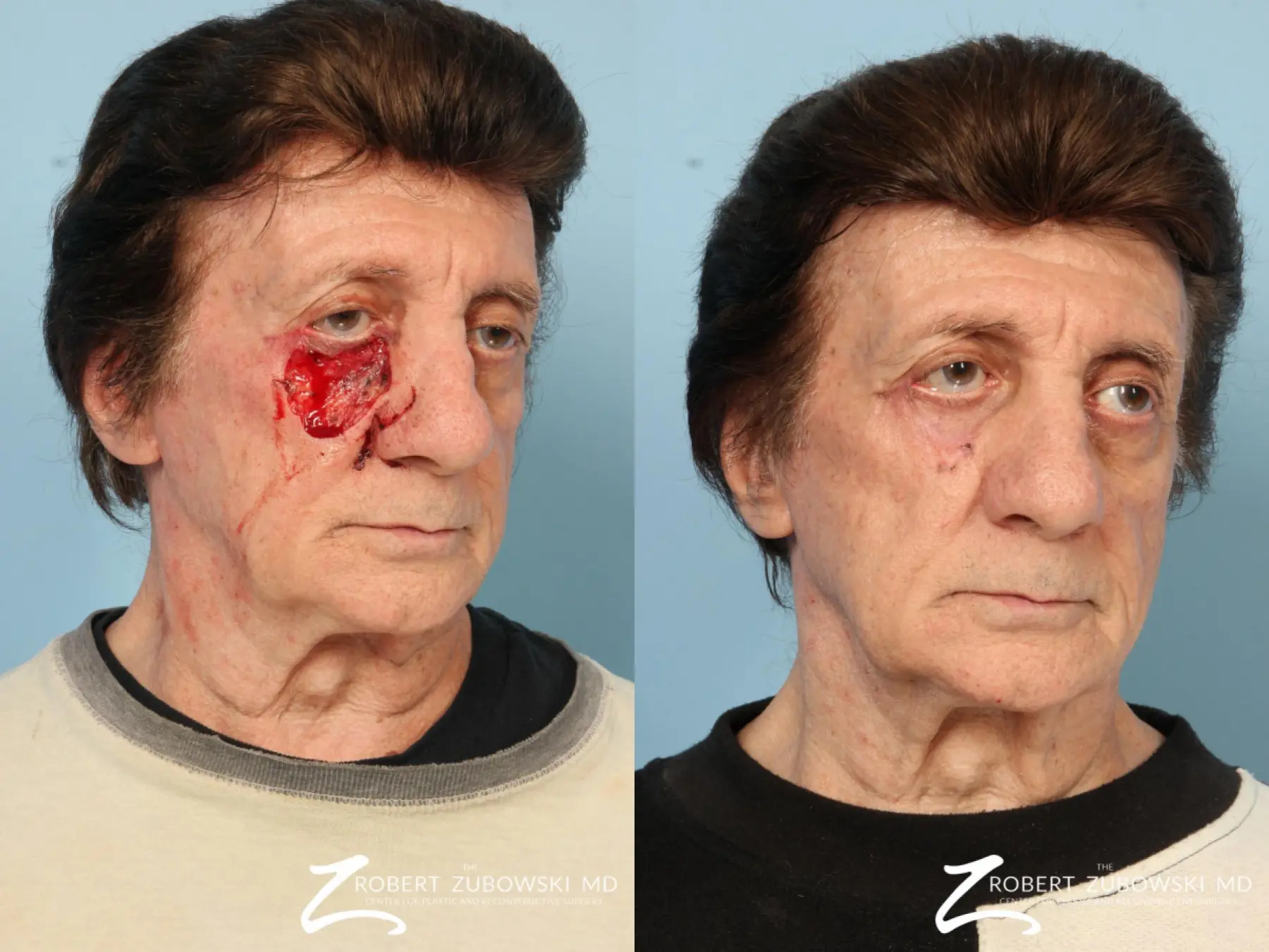 Mohs Closure: Patient 6 - Before and After  