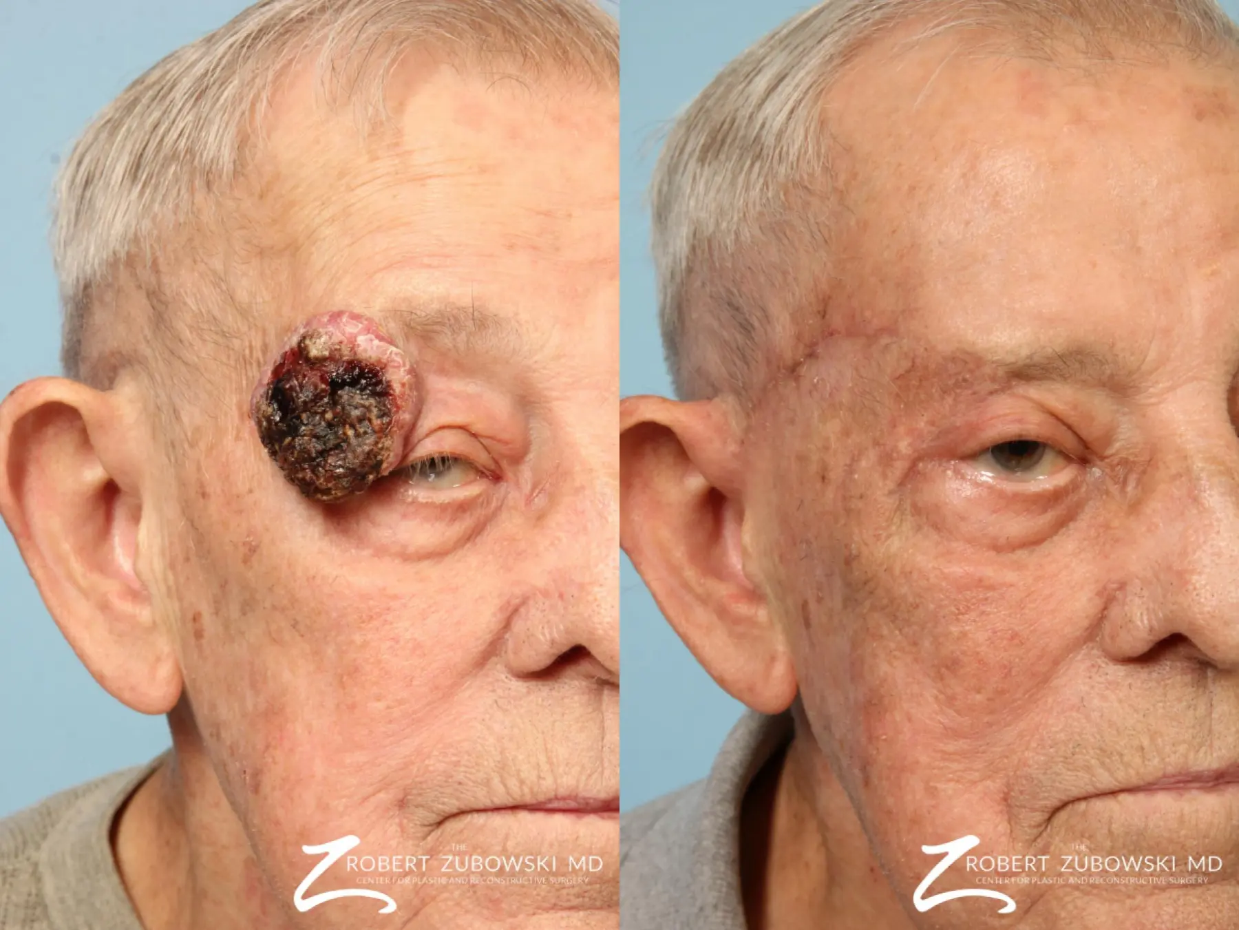 Mohs Closure For Men: Patient 1 - Before and After 2