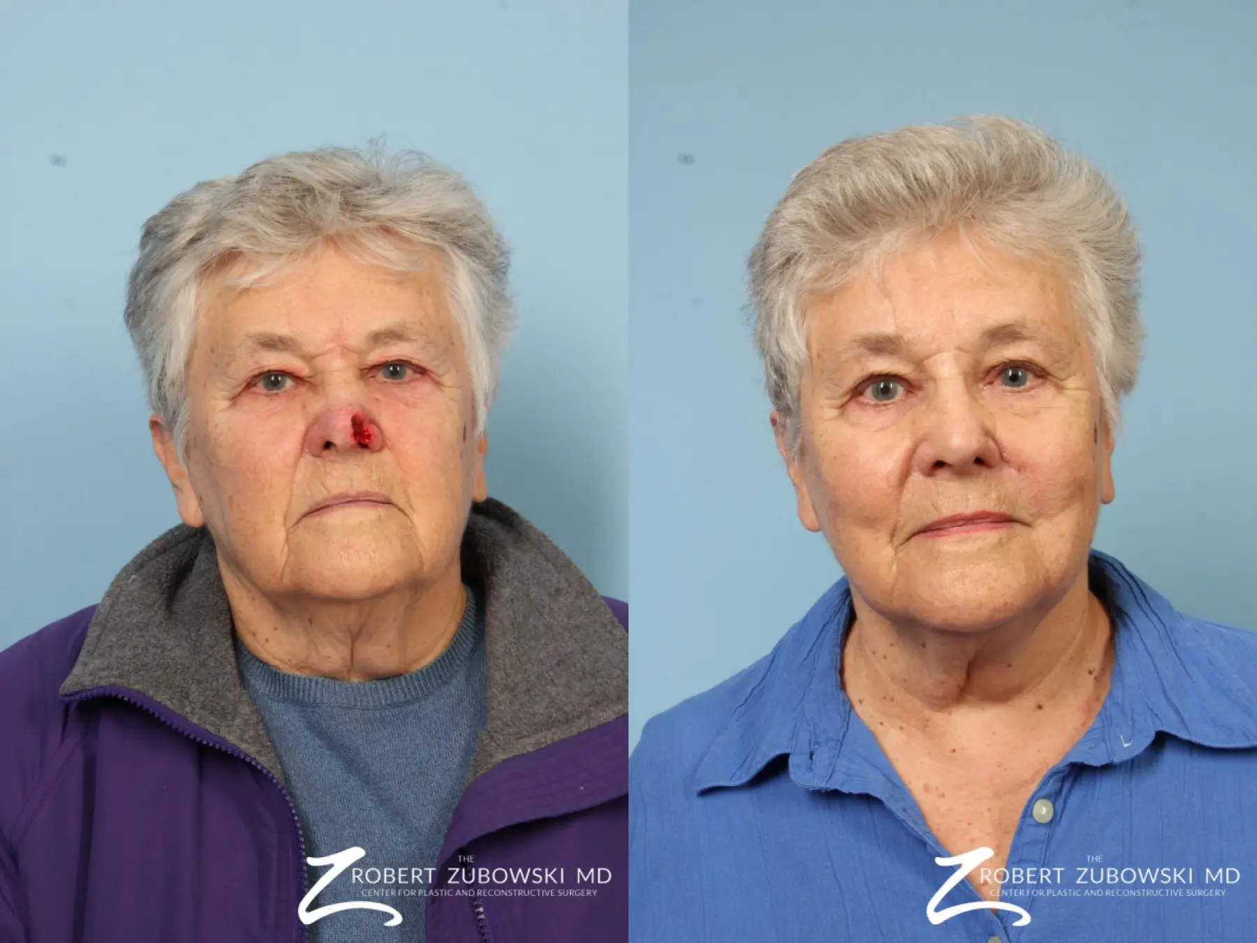 Mohs Closure: Patient 5 - Before and After  
