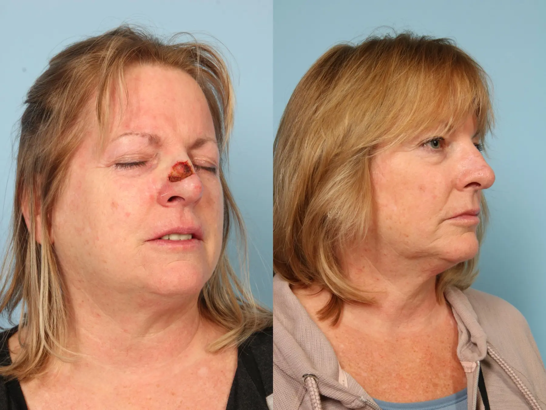Mohs Closure: Patient 1 - Before and After  