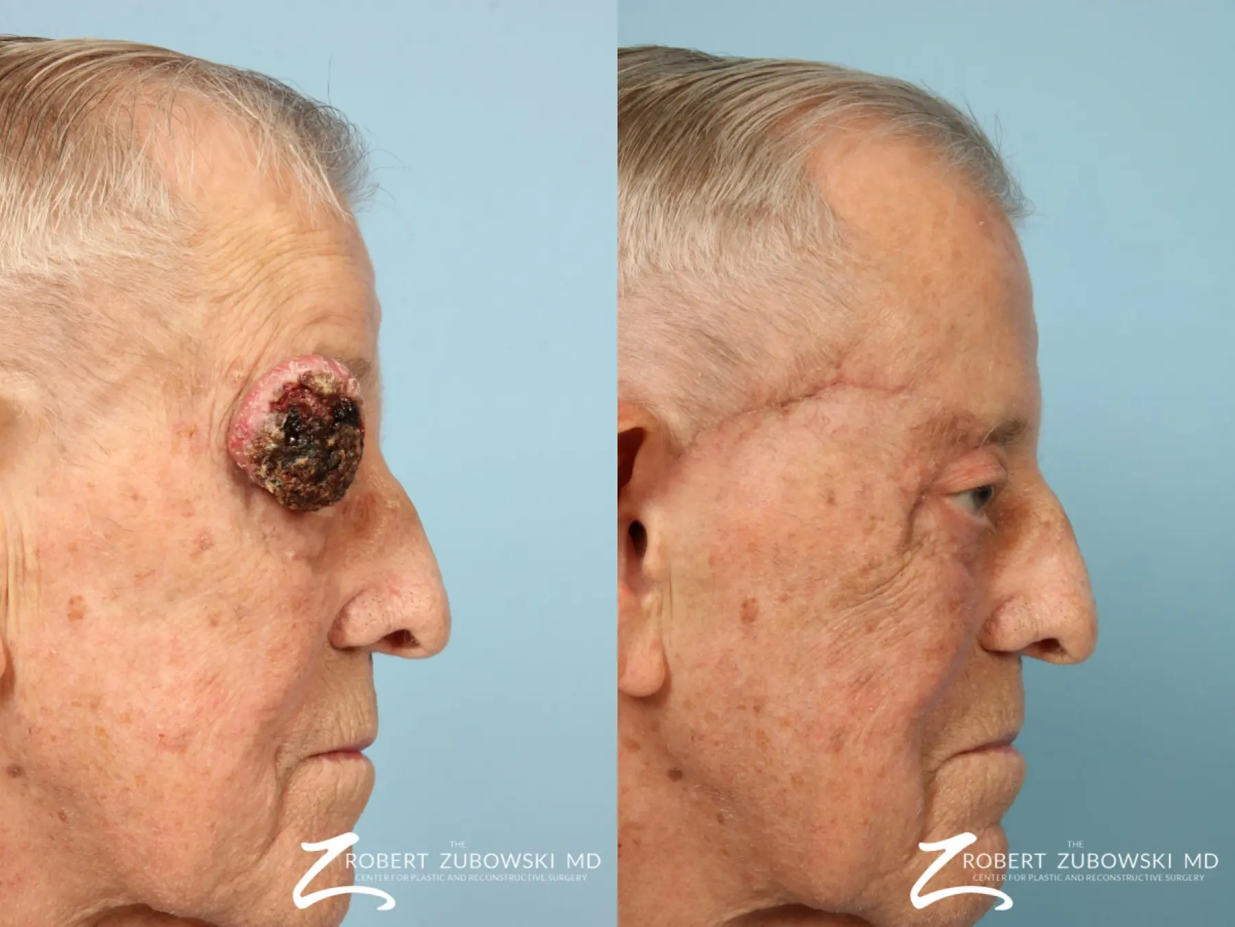 Mohs Closure For Men: Patient 1 - Before and After 3
