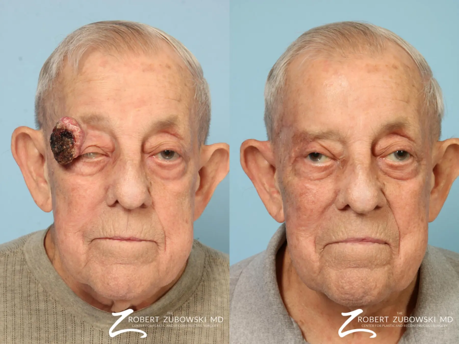 Mohs-closure-for-men: Patient 1 - Before and After  