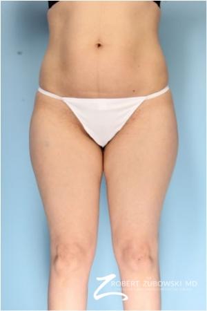 Liposuction: Patient 42 - Before Image 1
