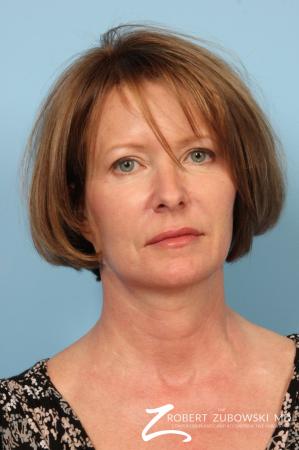 Ultherapy®: Patient 1 - After Image 1
