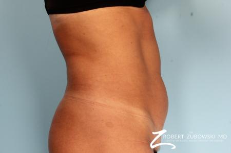 CoolSculpting®: Patient 3 - Before and After Image 2