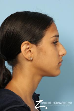 Rhinoplasty: Patient 14 - Before and After Image 2