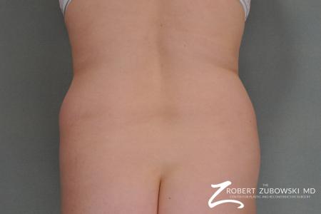 Liposuction: Patient 8 - Before Image 1