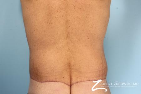 Body Lift: Patient 8 - After Image 2