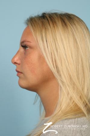 Rhinoplasty: Patient 23 - After Image 2