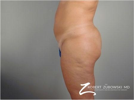 Liposuction: Patient 41 - After Image 2