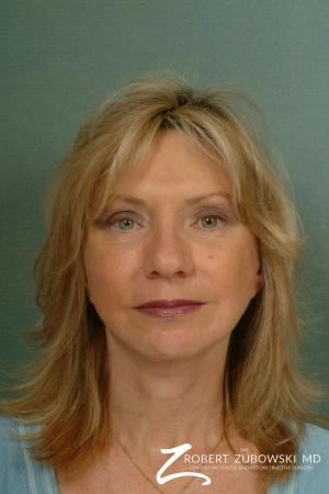 Facelift: Patient 13 - After Image 1