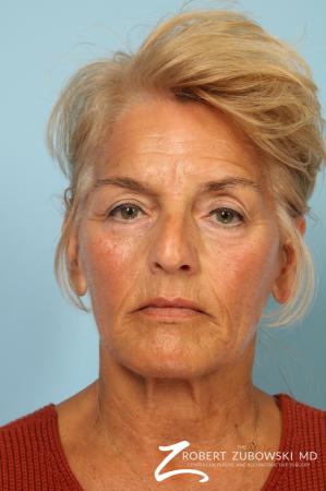 Facelift: Patient 27 - Before Image 1