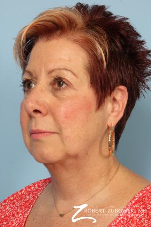 Blepharoplasty: Patient 13 - After Image 2