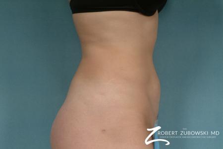 Liposuction: Patient 29 - After Image 3