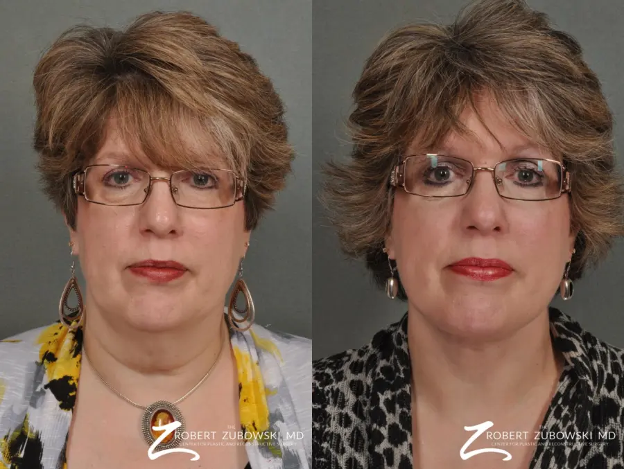 Neck Lift: Patient 7 - Before and After 1