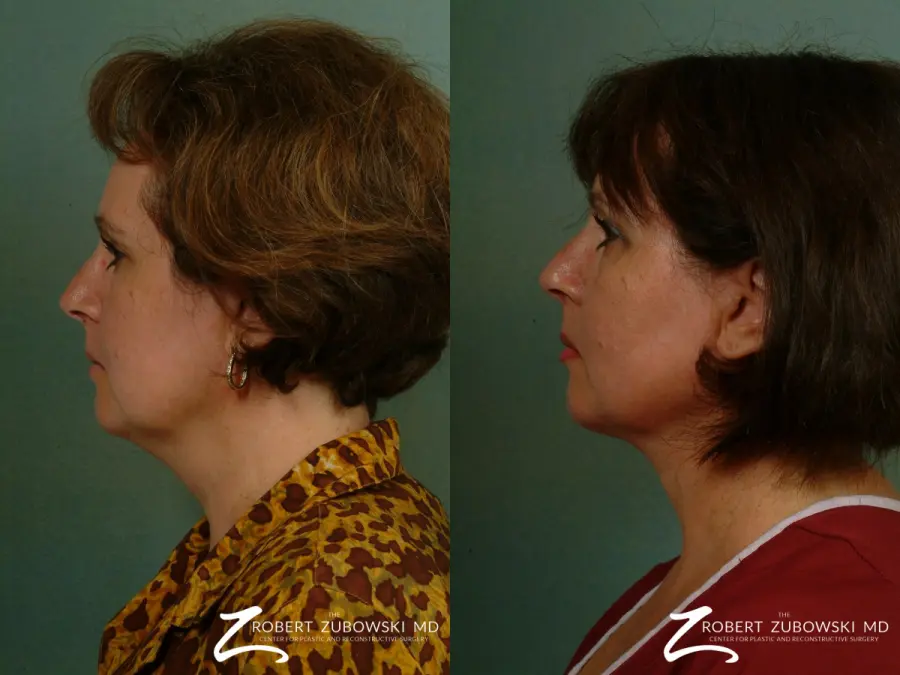 Neck Lift: Patient 9 - Before and After 2
