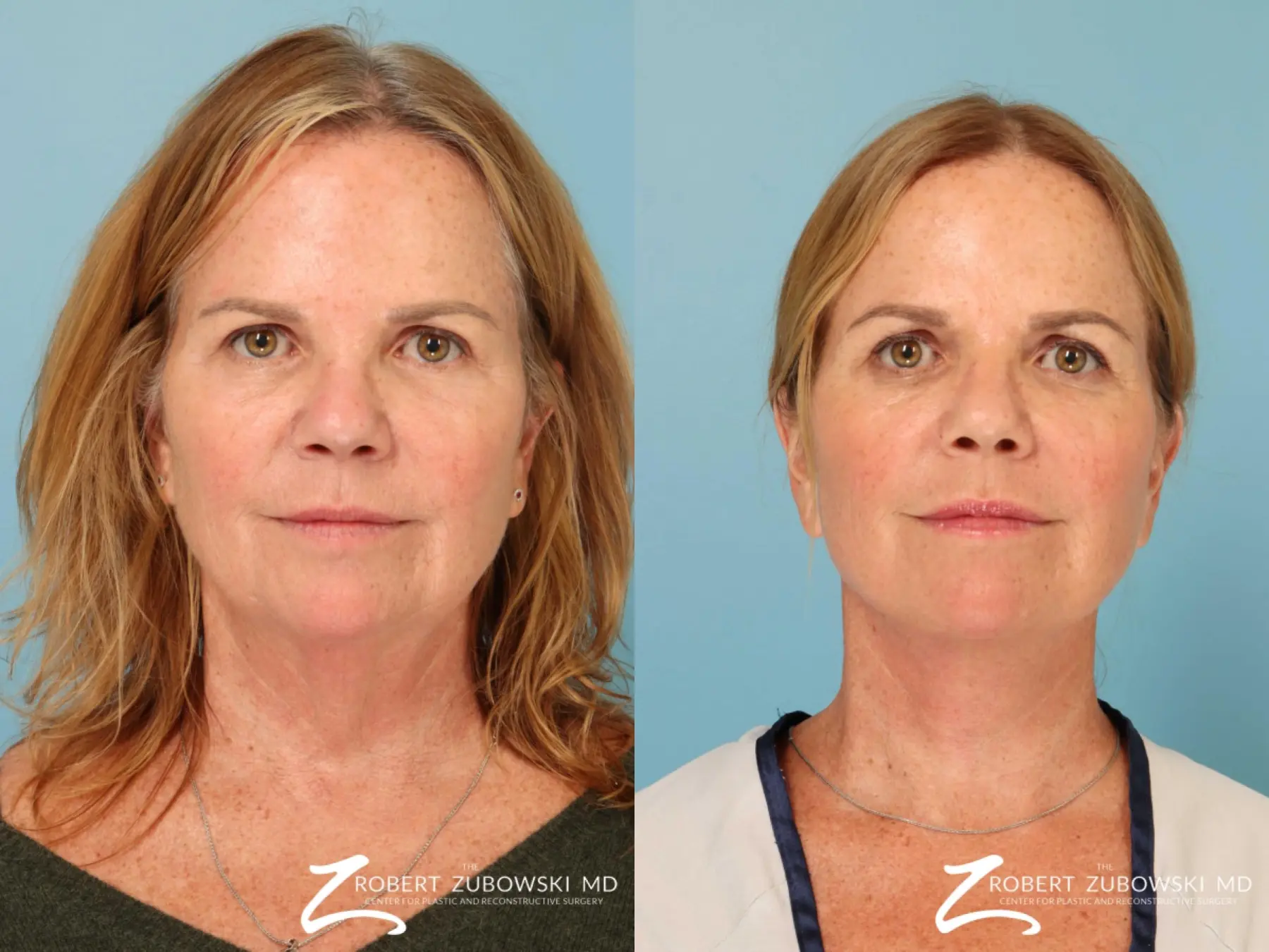 Neck Lift: Patient 11 - Before and After  