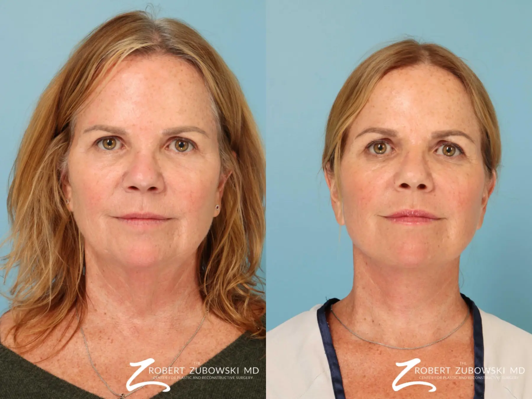 Neck Lift: Patient 11 - Before and After