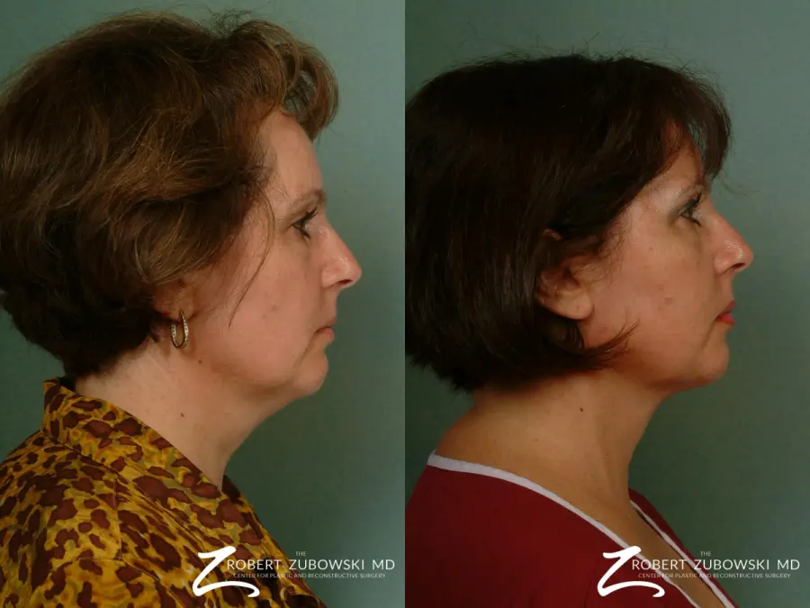 Neck Lift: Patient 9 - Before and After 3