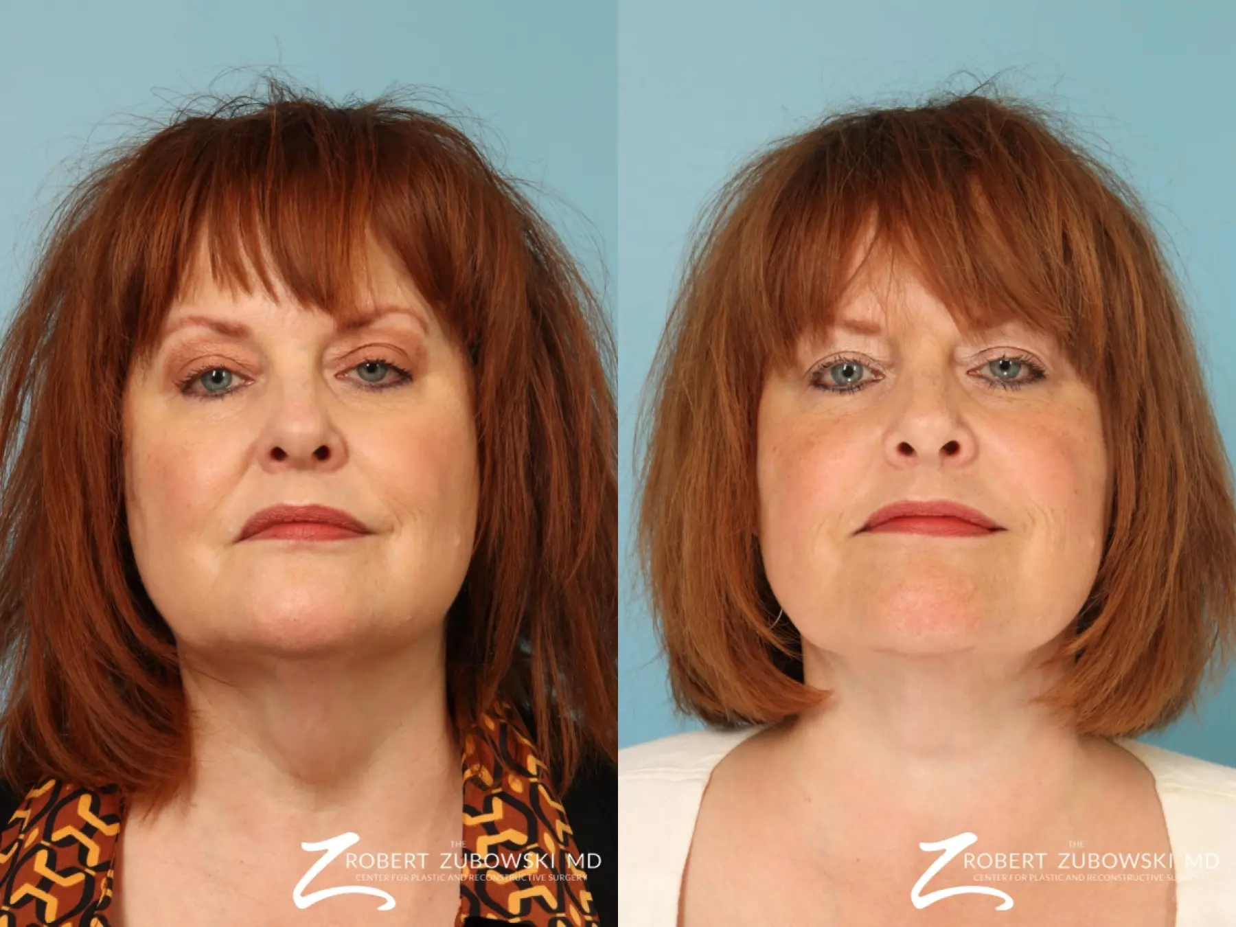 Neck Lift: Patient 12 - Before and After  