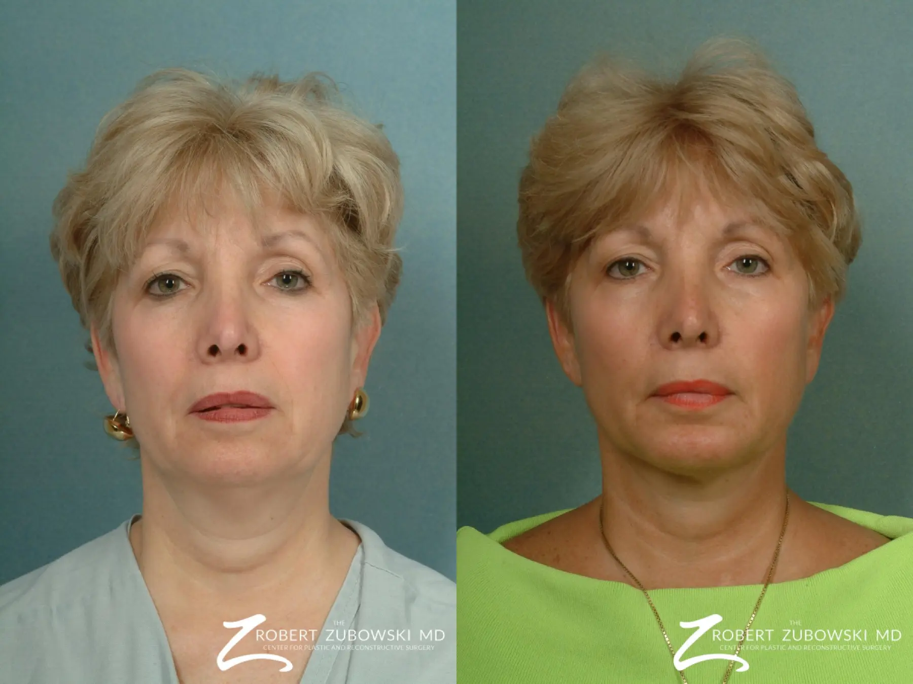 Neck Lift: Patient 4 - Before and After  