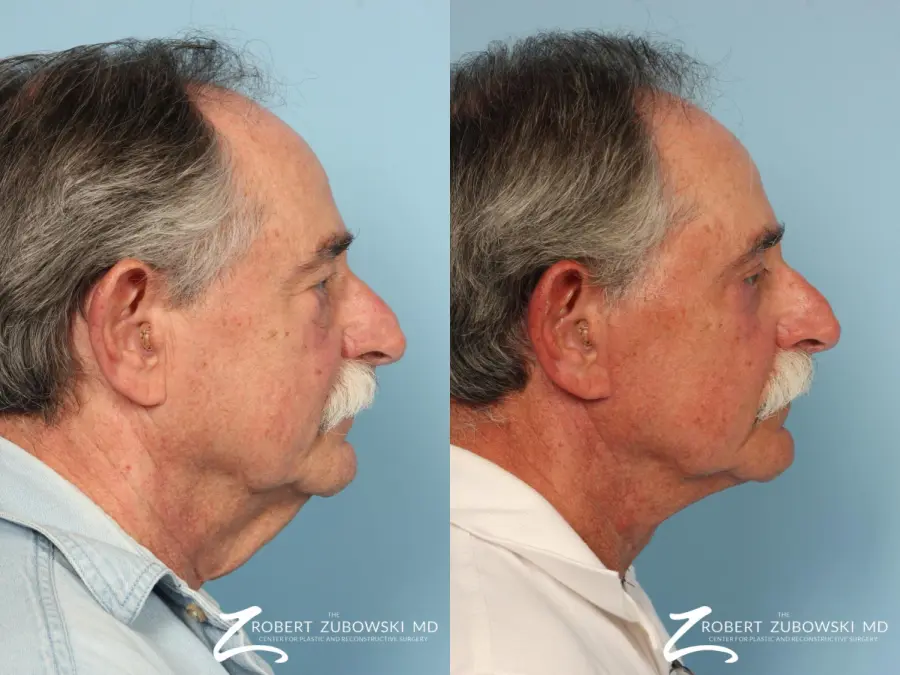 Neck Lift: Patient 7 - Before and After 2