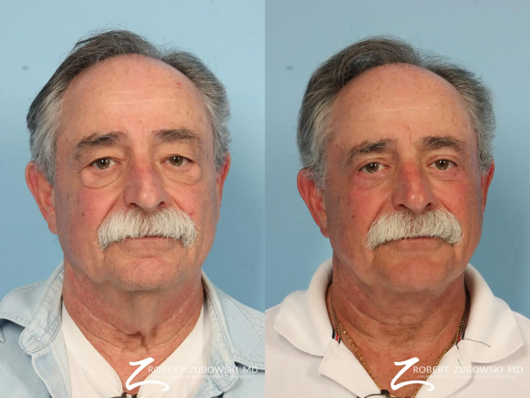 Neck Lift: Patient 7 - Before and After