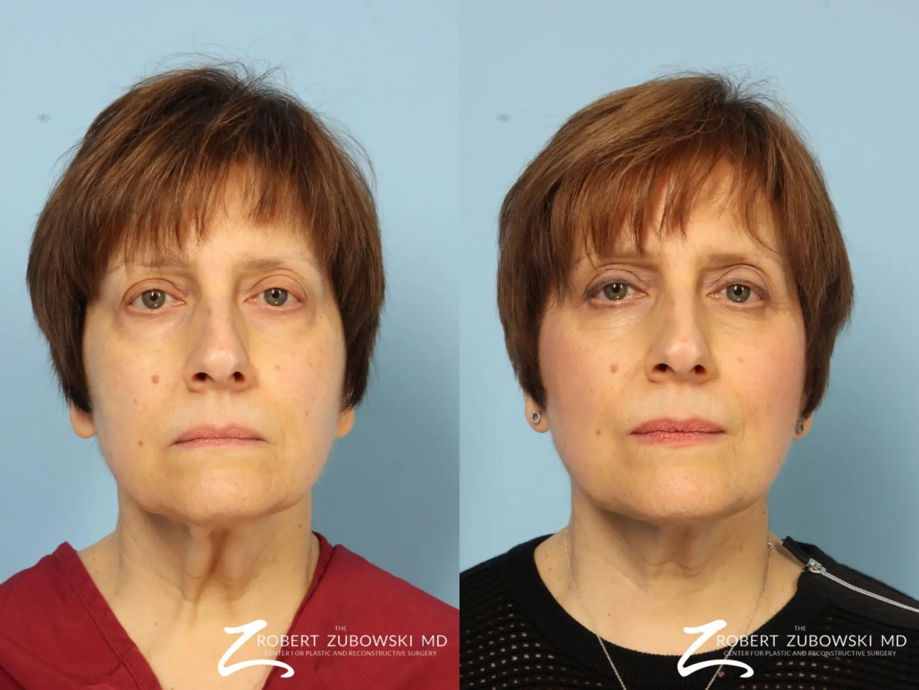 Neck Lift: Patient 3 - Before and After  