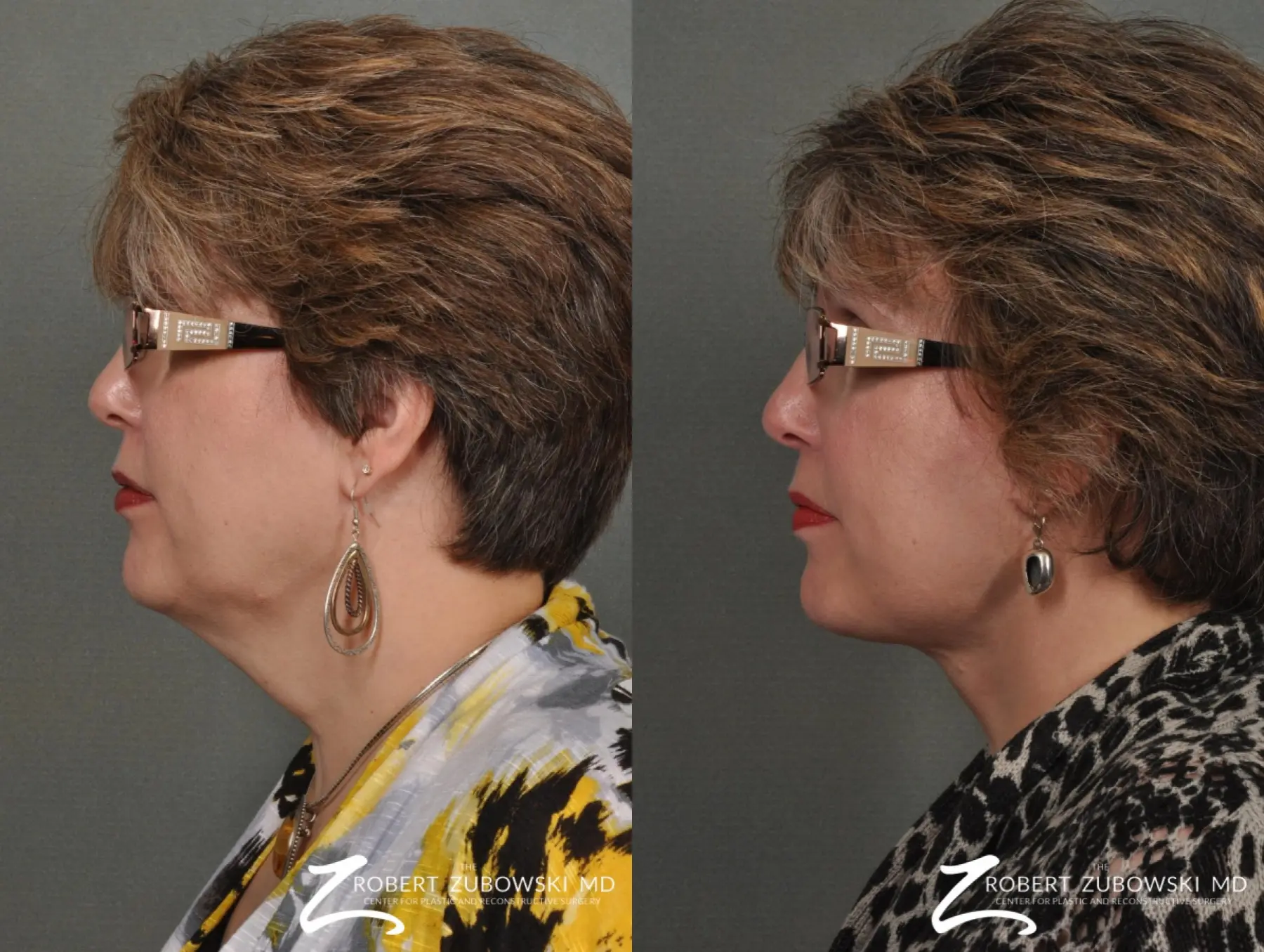 Neck Lift: Patient 8 - Before and After 2