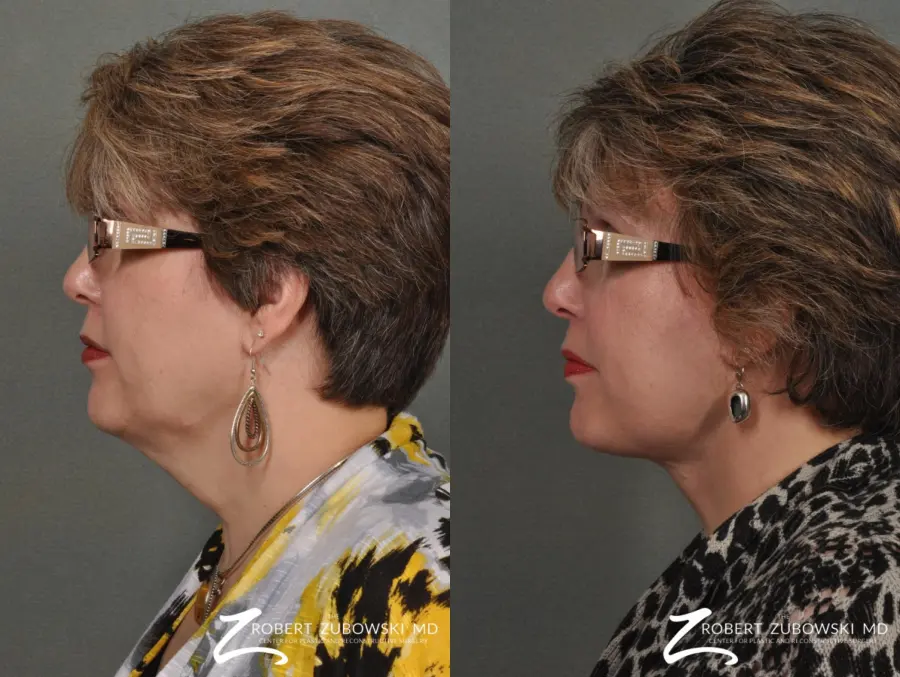 Neck Lift: Patient 7 - Before and After 2