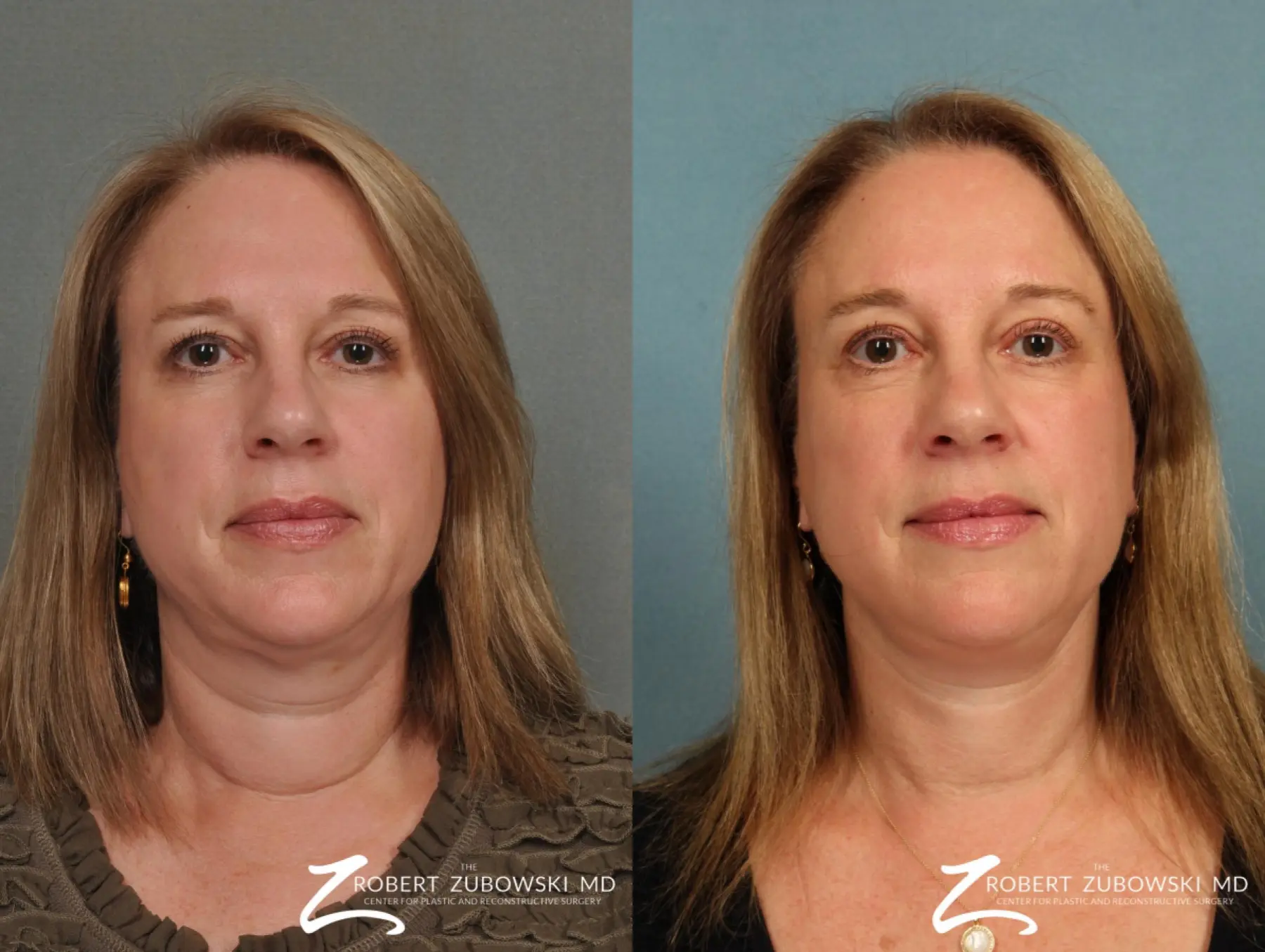 Neck Lift: Patient 2 - Before and After  