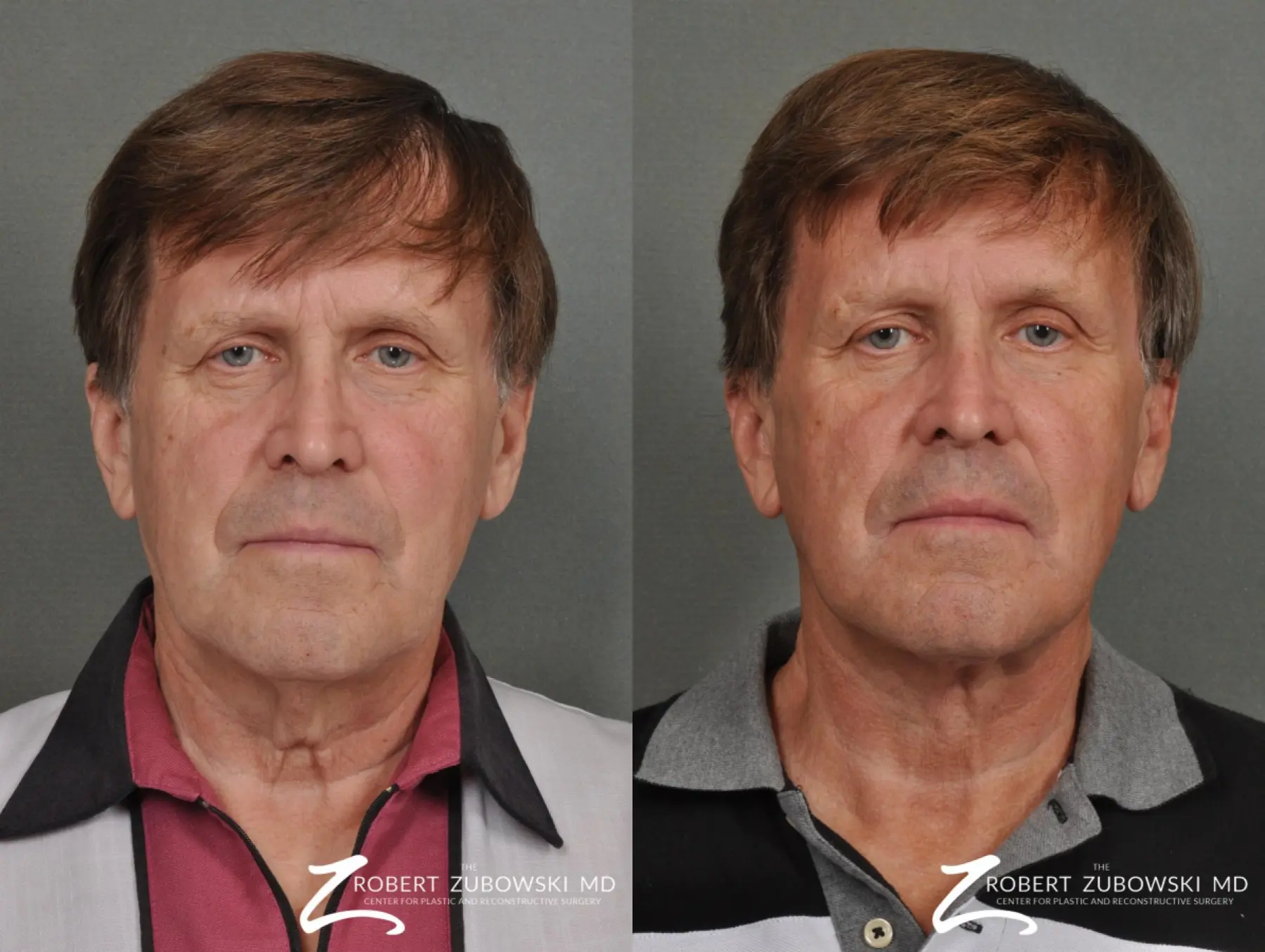 Neck Lift: Patient 5 - Before and After  
