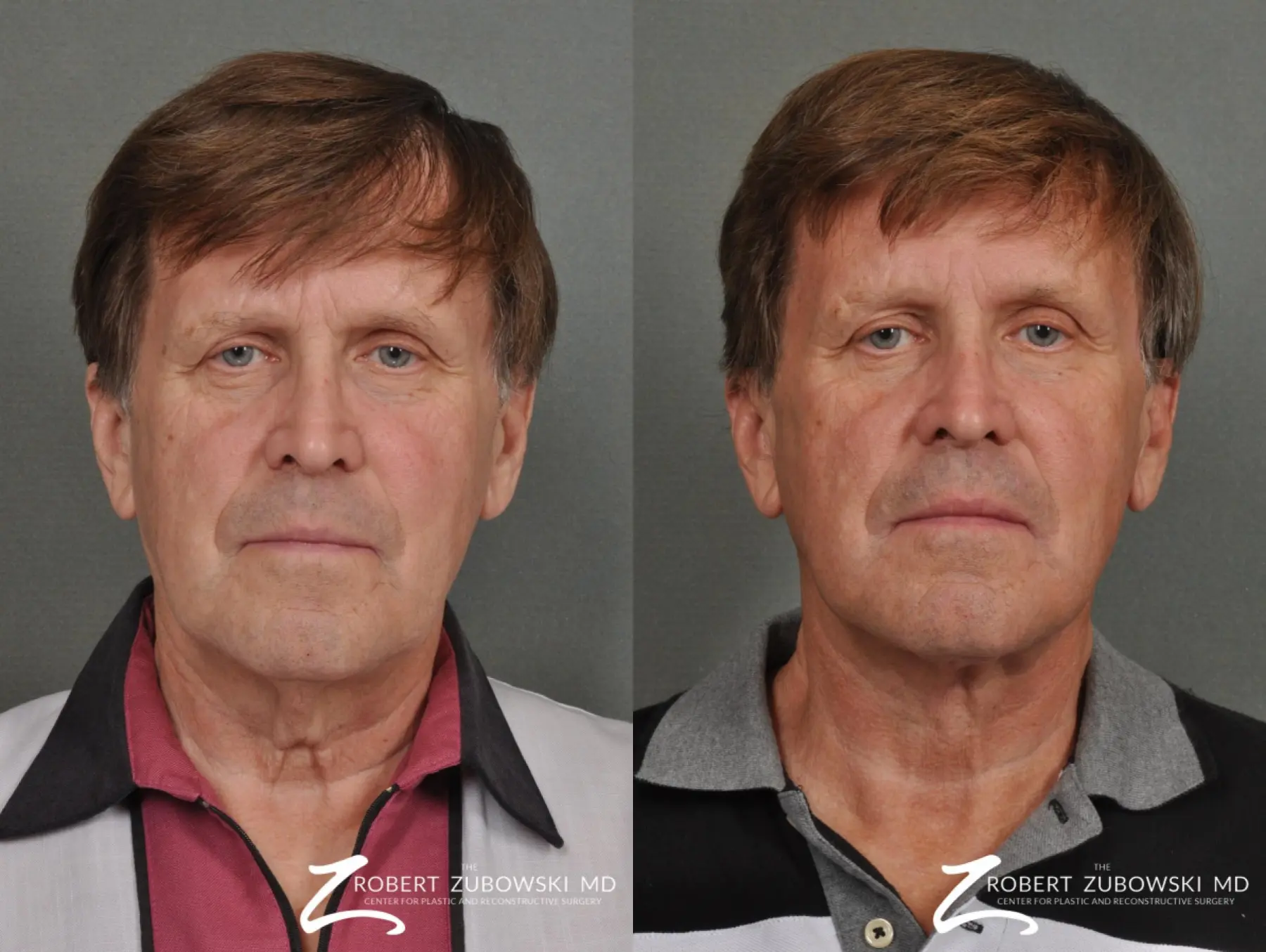 Neck Lift: Patient 5 - Before and After