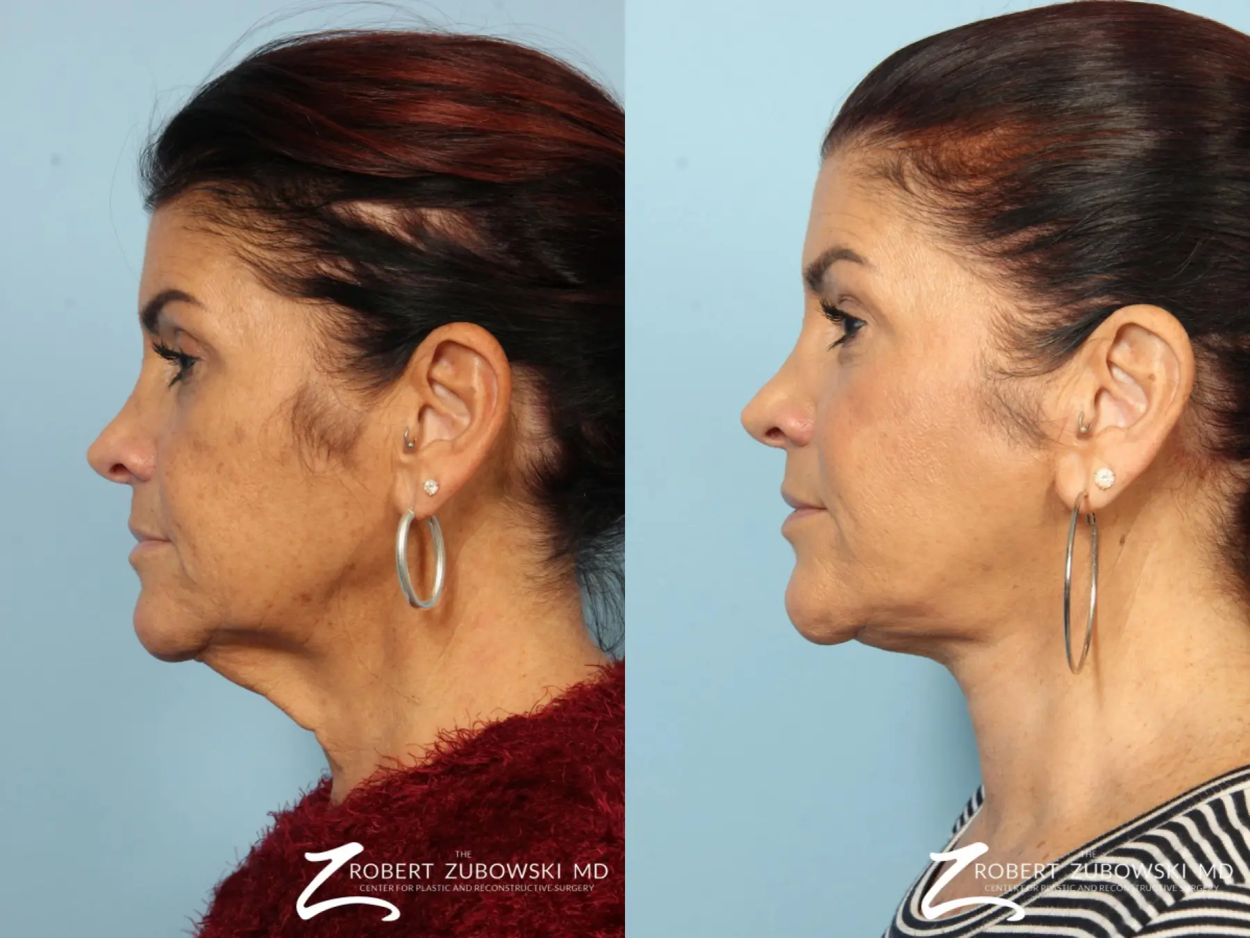 Neck Lift: Patient 1 - Before and After 3