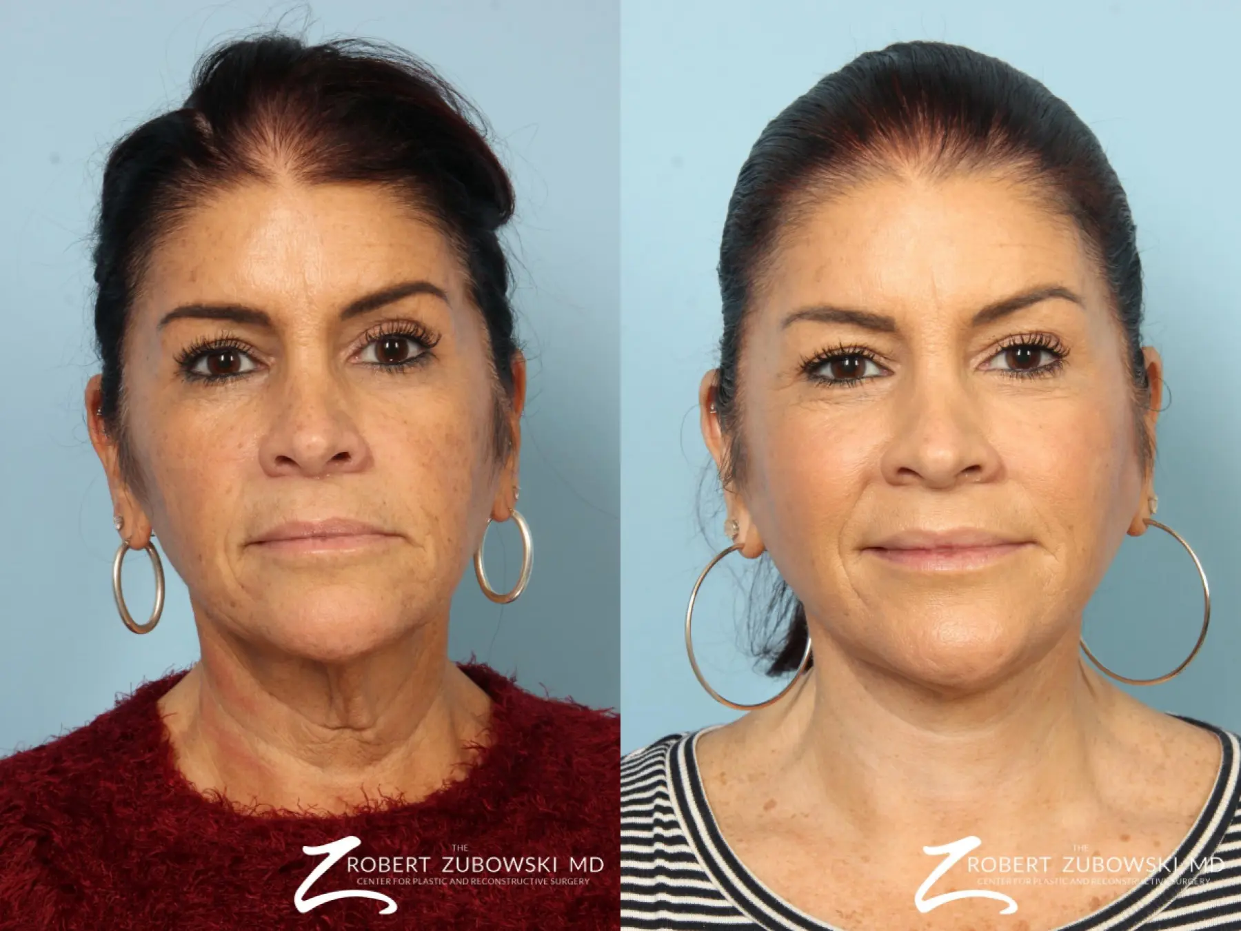 Neck Lift: Patient 1 - Before and After  