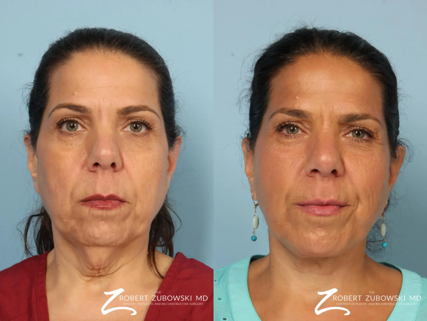 Neck Lift: Patient 10 - Before and After  