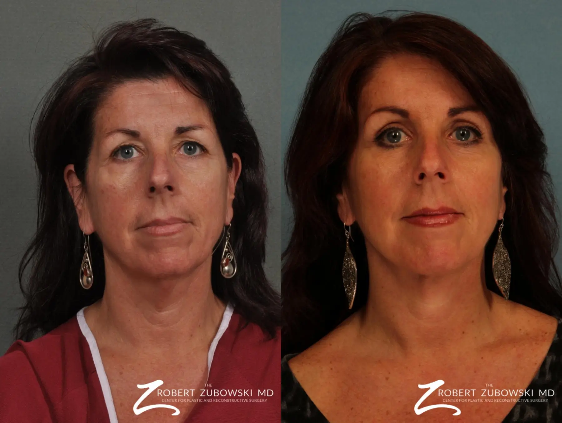 Neck Lift: Patient 6 - Before and After  