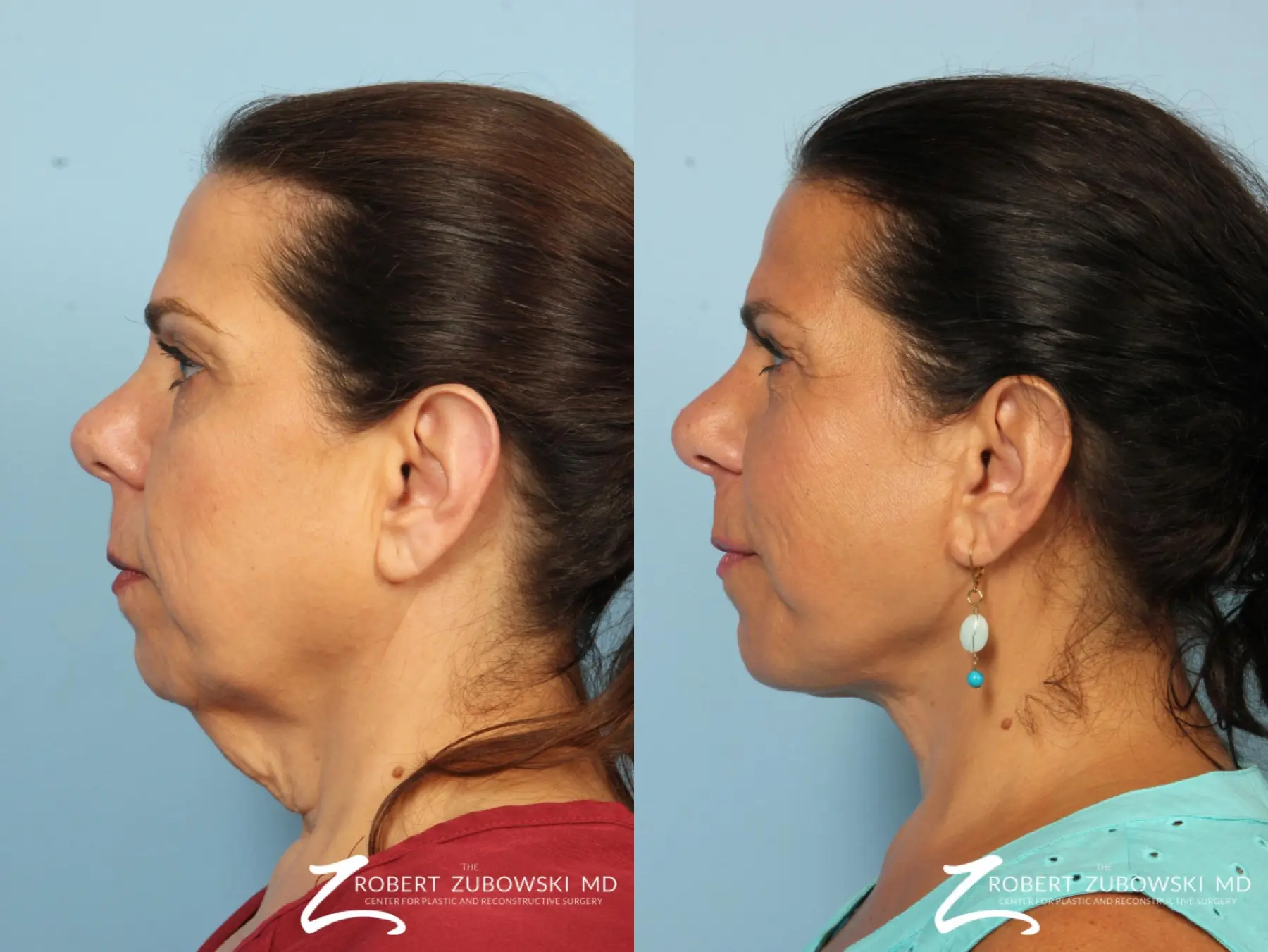 Neck Lift: Patient 10 - Before and After 3
