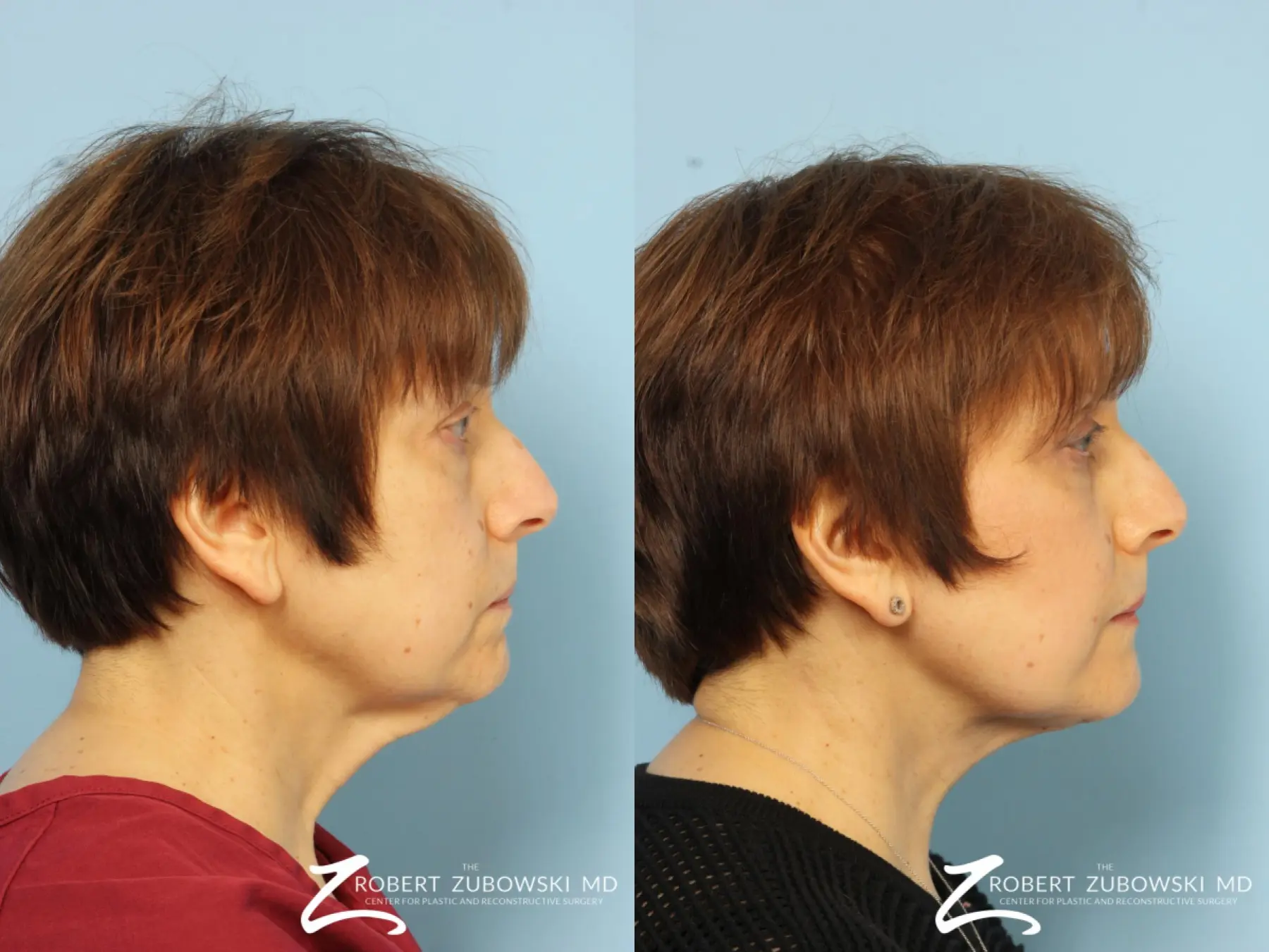 Neck Lift: Patient 3 - Before and After 2
